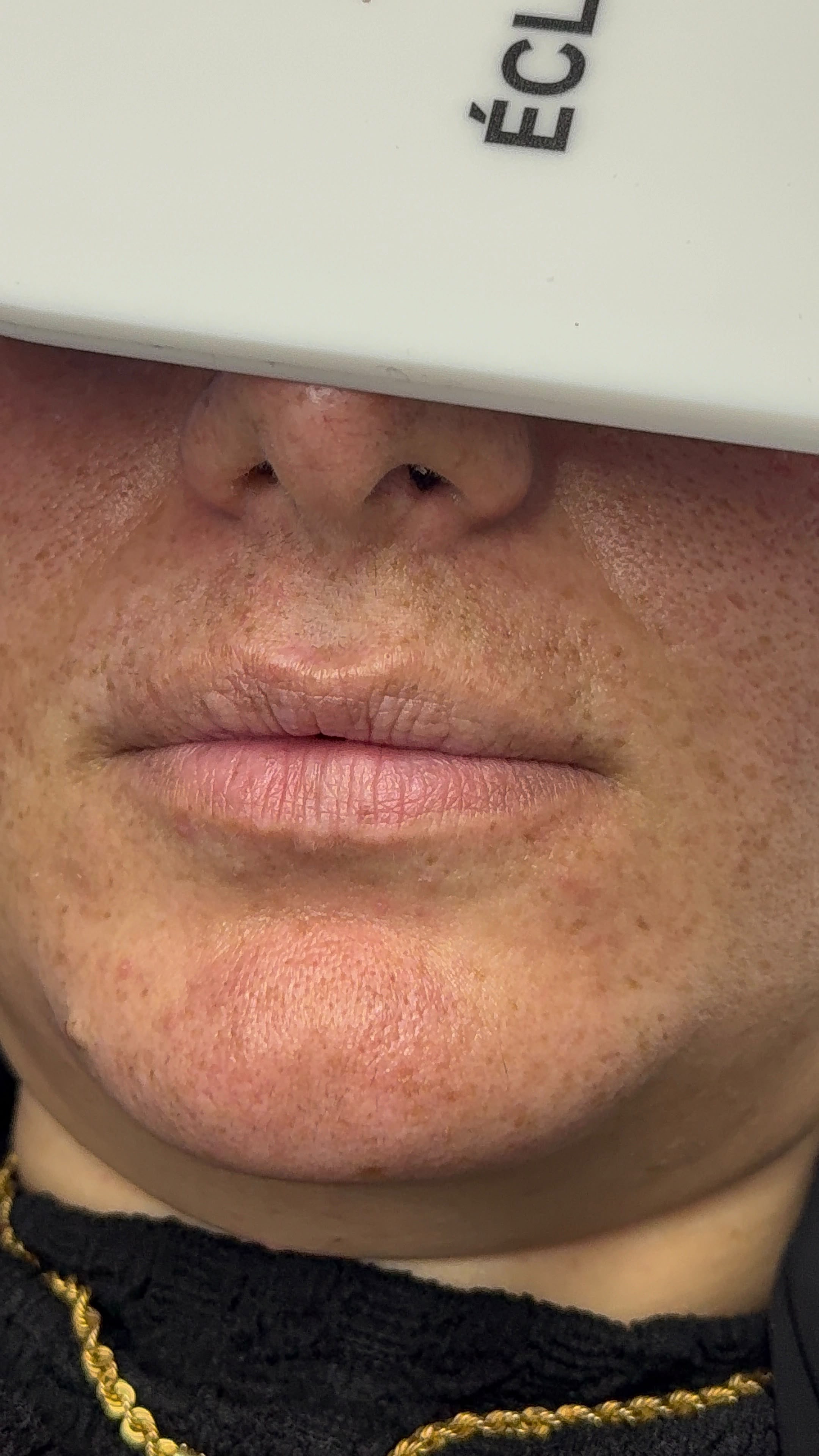 Lip treatment result
